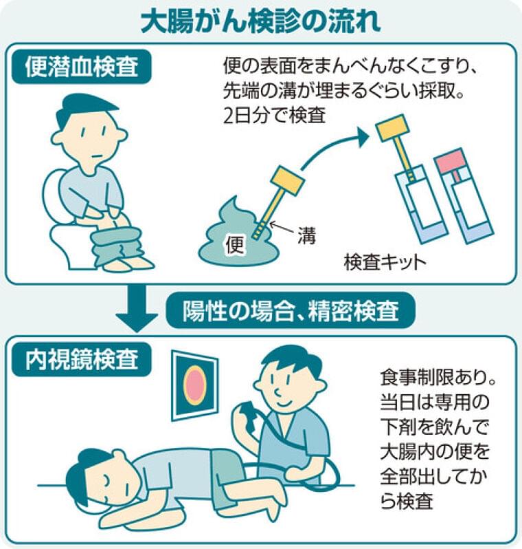 大腸がんの便潜血検査、便採取を２日分から１日分に変更へ…がん発見割合に差なく負担を軽減 | ヨミドクター(読売新聞)
