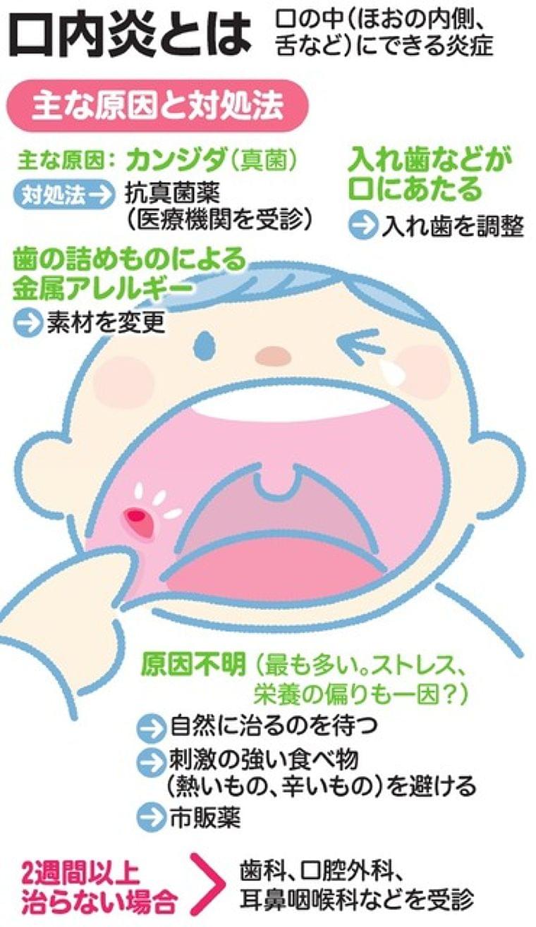 つらい口内炎 早く治すには 朝日新聞デジタル ニュース Eatreat つらい口内炎 早く治すには 朝日新聞デジタル ニュース Eatreat