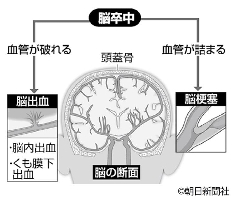 人は血管とともに老いる 血管の2大トラブルとは? (1/2) 〈週刊朝日〉|AERA dot. (アエラドット)