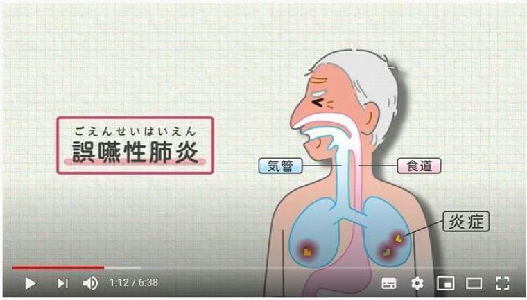 誤嚥性肺炎の予防方法は? 動画で解説、人工呼吸器不足の改善を図る/日清医療食品|食品産業新聞社ニュースWEB