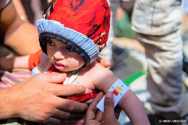 イエメン：5歳未満児の栄養不良が急増【プレスリリース】｜公益財団法人日本ユニセフ協会のプレスリリース