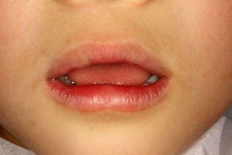 「お口ぽかん」歯科通院の子どもの3割 高年齢ほど割合高く 鹿児島大学病院など全国調査 | 鹿児島のニュース | 南日本新聞 | 373news.com