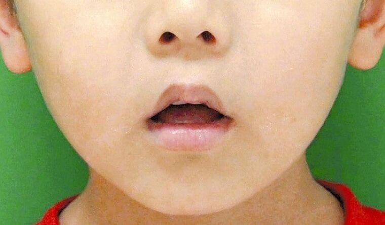 「お口ぽかん」全国調査で子どもの3割、想定外の結果に…成長期には難しい自然治癒 : 医療・健康 : 読売新聞オンライン