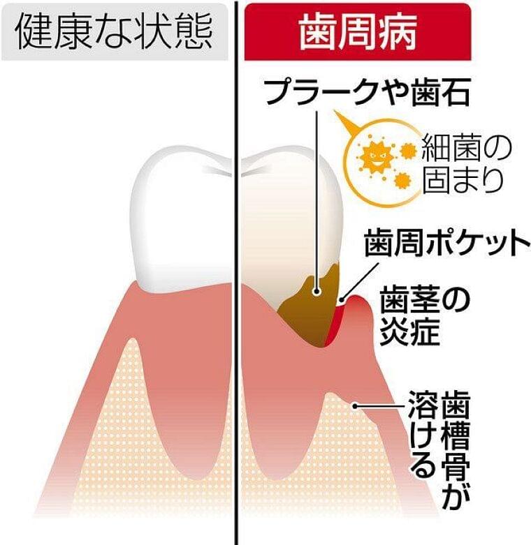 歯周病は「万病のもと」　糖尿病悪化や誤嚥性肺炎に：東京新聞 TOKYO Web