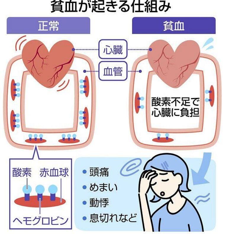 汗と流れて鉄分不足 夏の貧血 スポーツにも注意:東京新聞 TOKYO Web