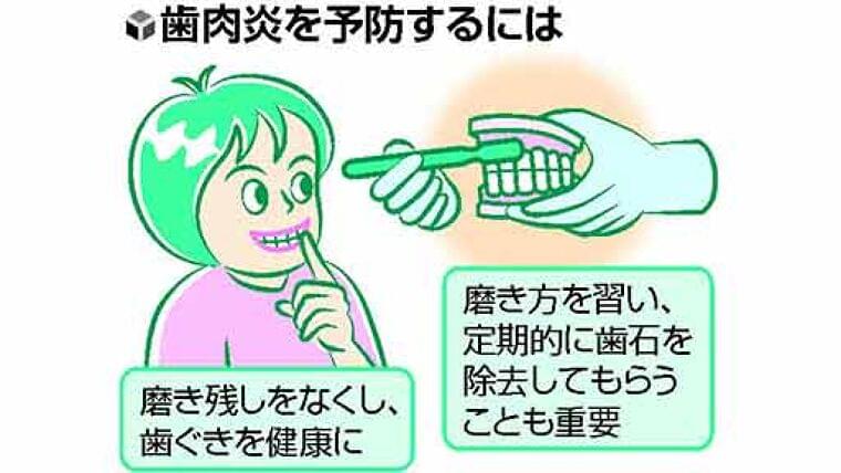 口の中の健康(10)小中学生の4割に歯肉炎 歯科医院で歯石の除去を | ヨミドクター(読売新聞)