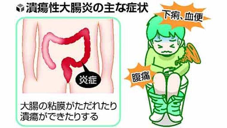おなかのトラブル(8)下痢、血便…子どもの潰瘍性大腸炎 急激に進行し大腸全体に | ヨミドクター(読売新聞)