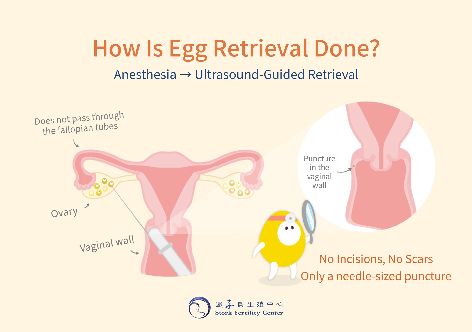 How is egg retrieval done? Anesthesia, then ultrasound-guided retrieval: the needle passes through the vaginal wall to the ovary and does not pass through the fallopian tubes. No incisions, no scars, only a needle-sized puncture in the vaginal wall