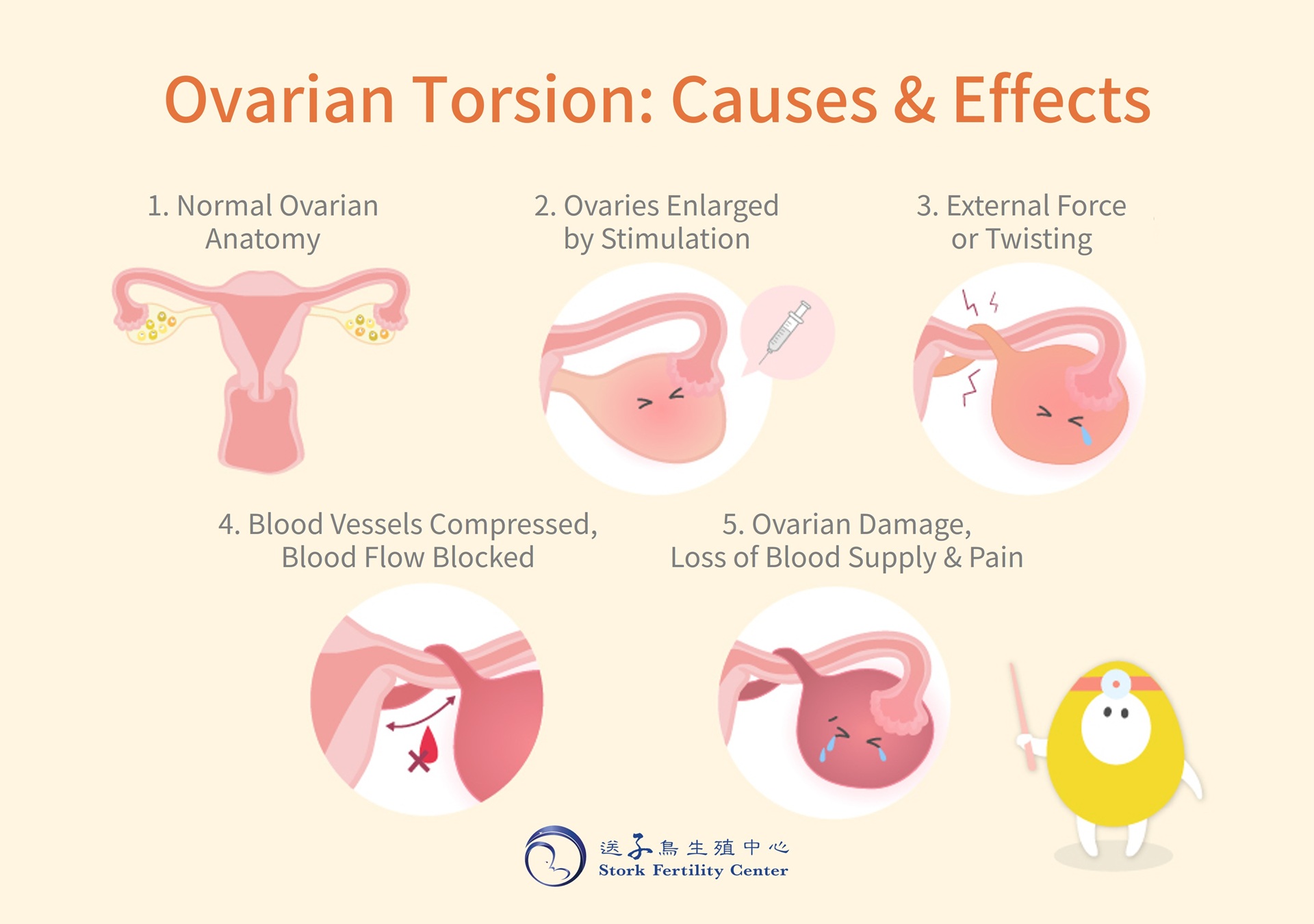 Ovarian torsion causes and effects: 1. normal ovarian anatomy, 2. ovaries enlarged by stimulation, 3. external force or twisting, 4. blood vessels compressed and blood flow blocked, 5. ovarian damage, loss of blood supply and pain