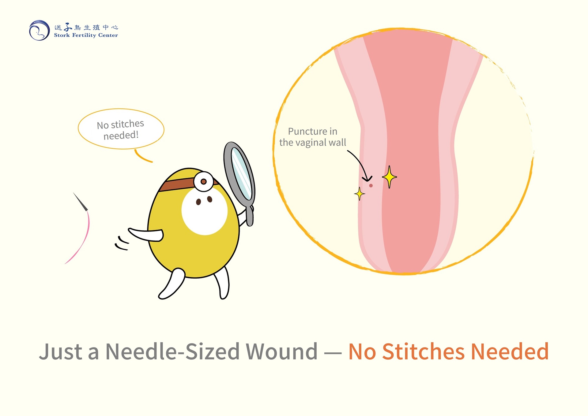 Just a needle-sized wound in the vaginal wall after egg retrieval, no stitches needed