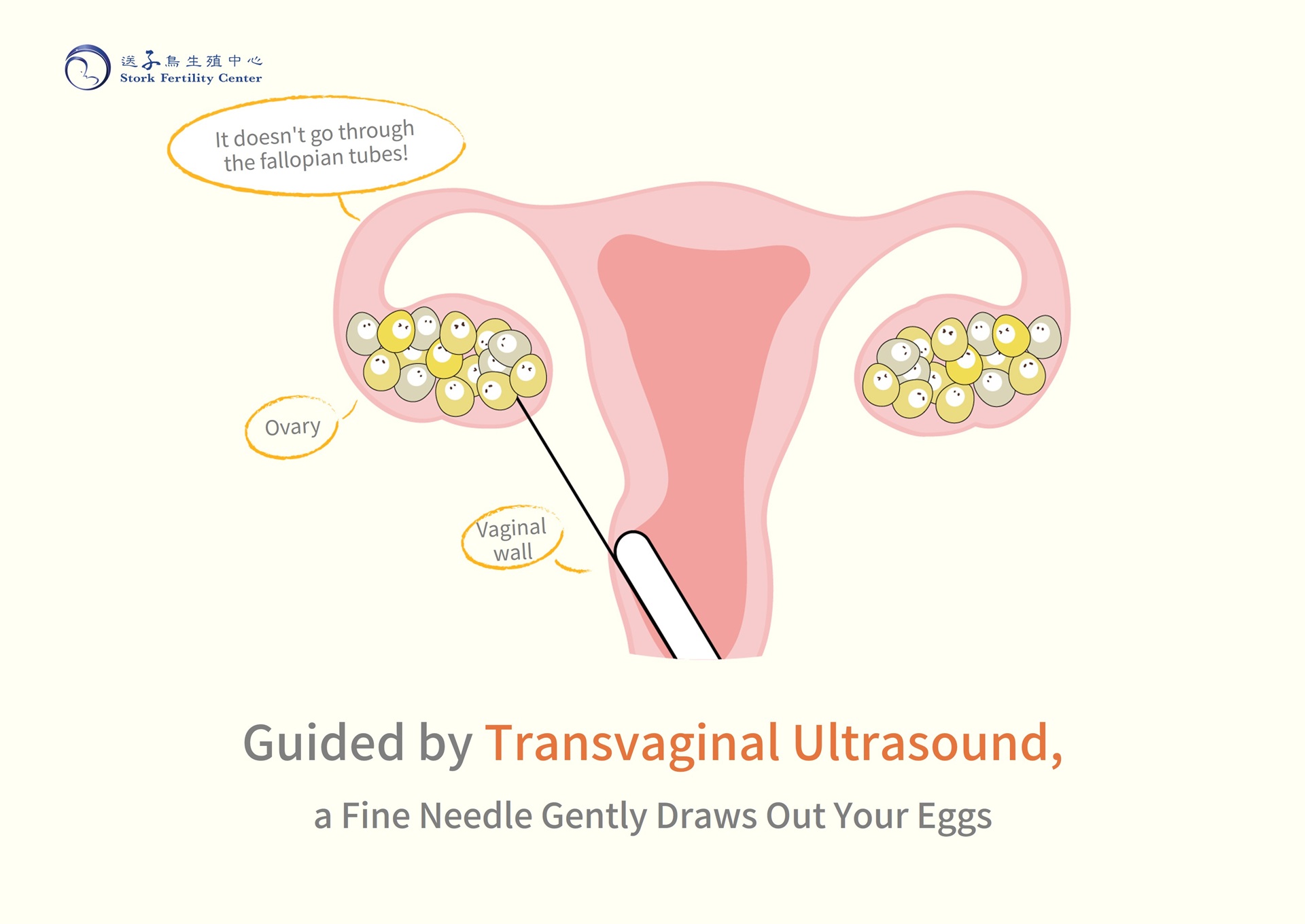 Guided by transvaginal ultrasound, a fine needle gently draws out your eggs through the vaginal wall. It doesn't go through the fallopian tubes