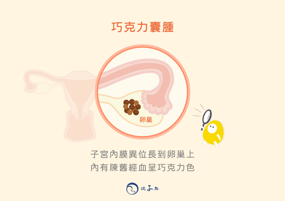 子宮內膜異位