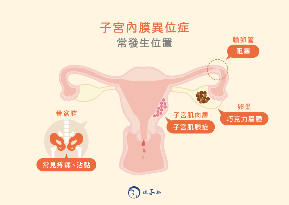 子宮內膜異位症 常發生位置