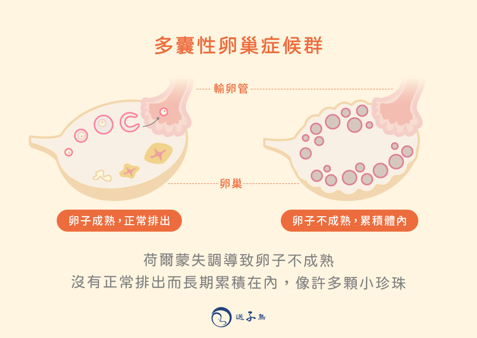 多囊性卵巢症候群 (PCOS)