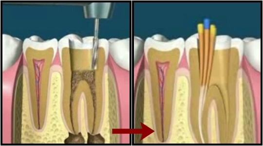 2 procedure