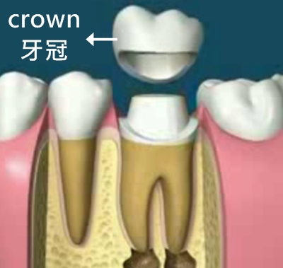 4 crown