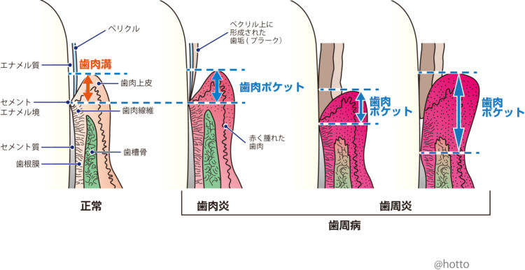 犬の歯周炎への進行ステージ