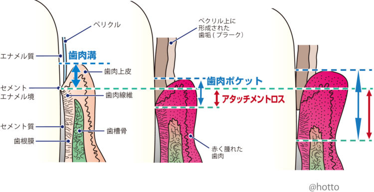歯周病を評価する「アタッチメントロス」