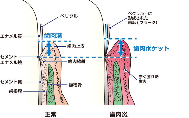 犬の歯肉炎になる仕組み
