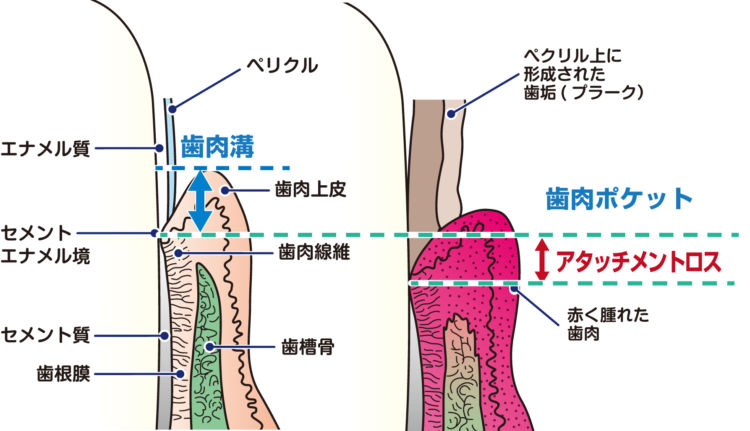 歯周病を評価 アタッチメントロス