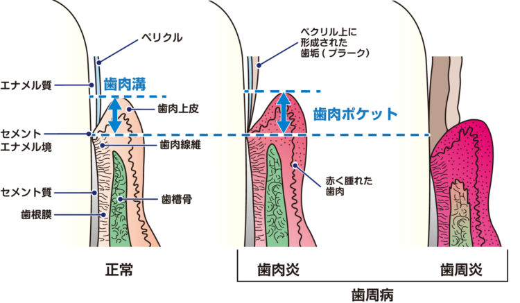 歯垢、歯石ができるまで