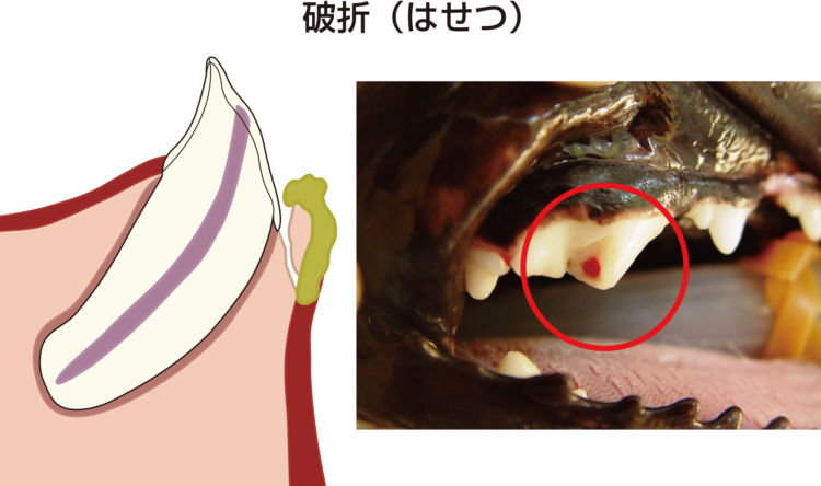 歯髄炎(しずいえん) 破折