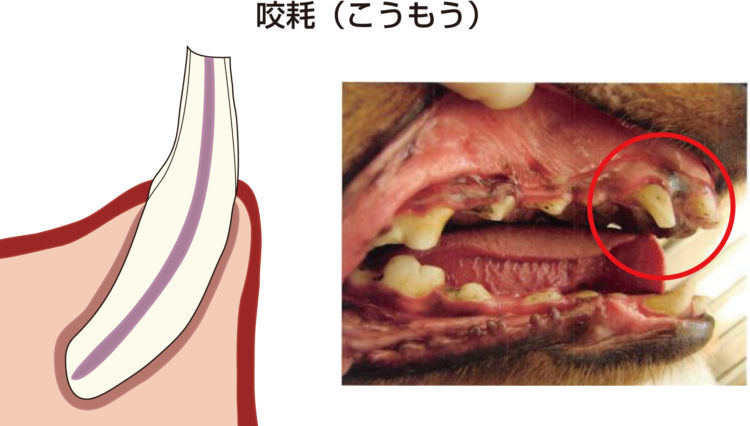 歯髄炎(しずいえん) 咬耗