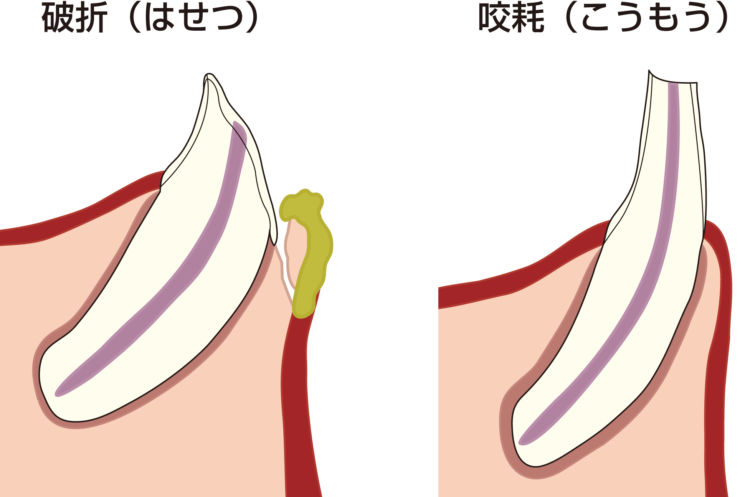 破折・咬耗を見逃さない