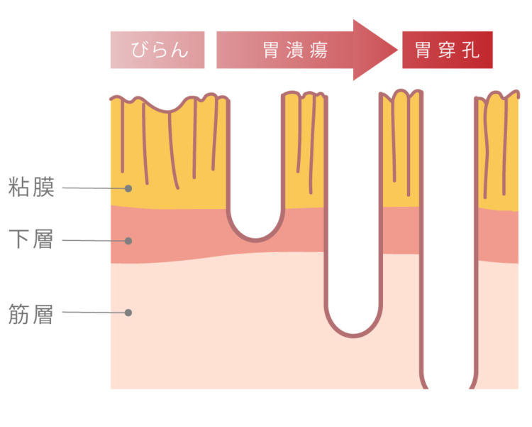図:胃の炎症の進行