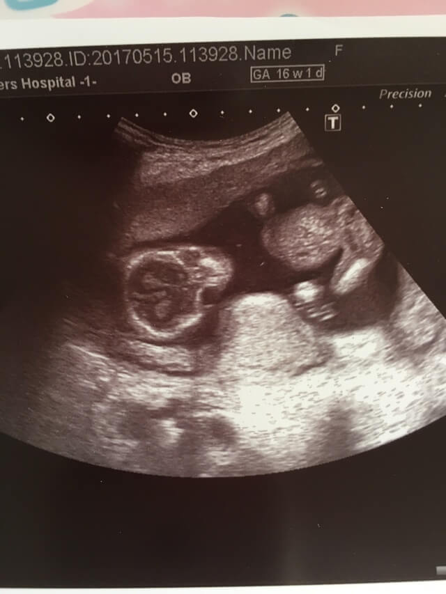 エコー写真 16週1日 16w1d 女の子,妊娠16週,エコー写真,