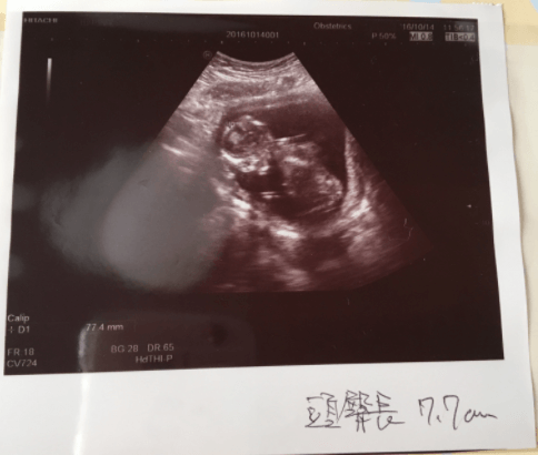 エコー写真 16週3日 16w3d 女の子,妊娠16週,エコー写真,