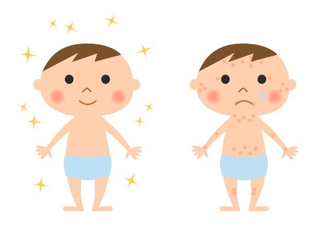 赤ちゃんとアレルギー,離乳食,ミルク,
