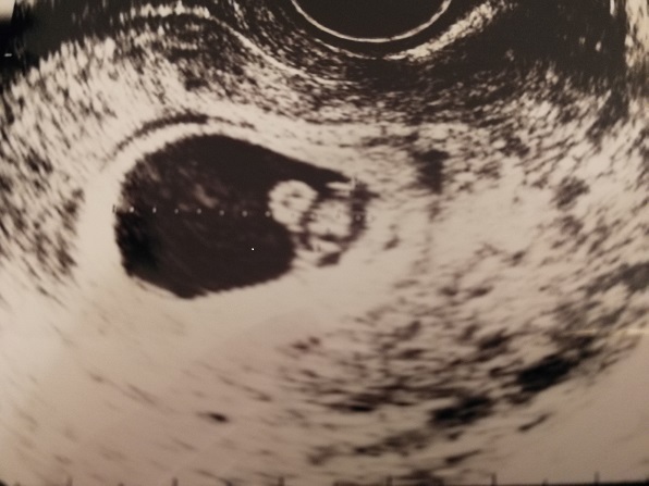 エコー写真 7週1日 7w1d 女の子,妊娠,7週,