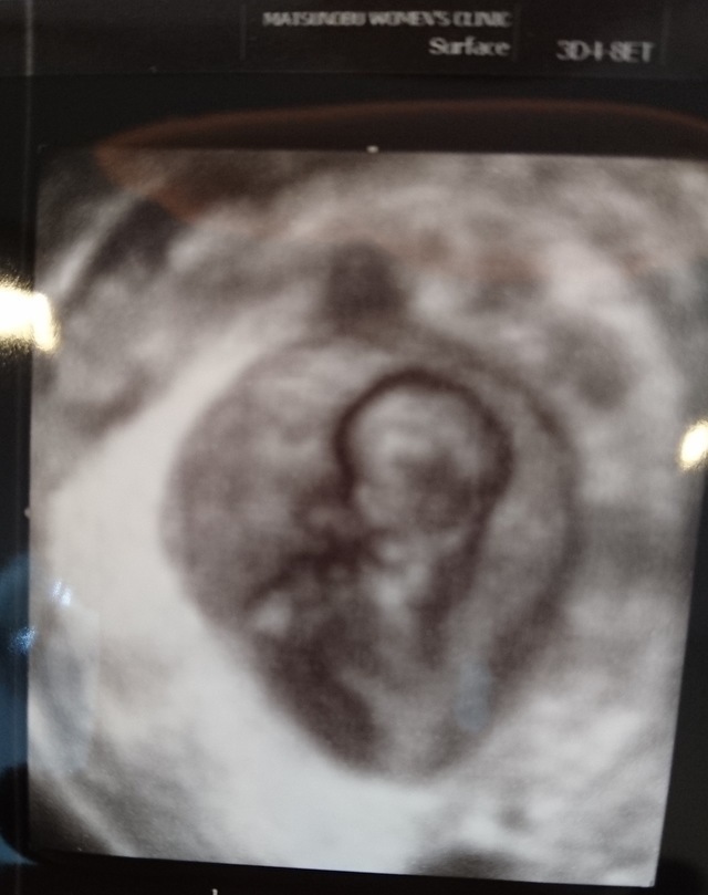 エコー写真 9週6日 9w6d 男の子,妊娠,9週,エコー写真