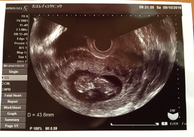 エコー写真 10週5日 10w5d 女の子,妊娠10週,エコー,