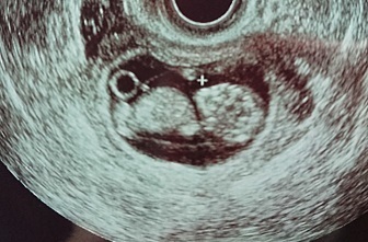 エコ―写真 10週6日 10w6d 性別不明,妊娠10週,エコー,