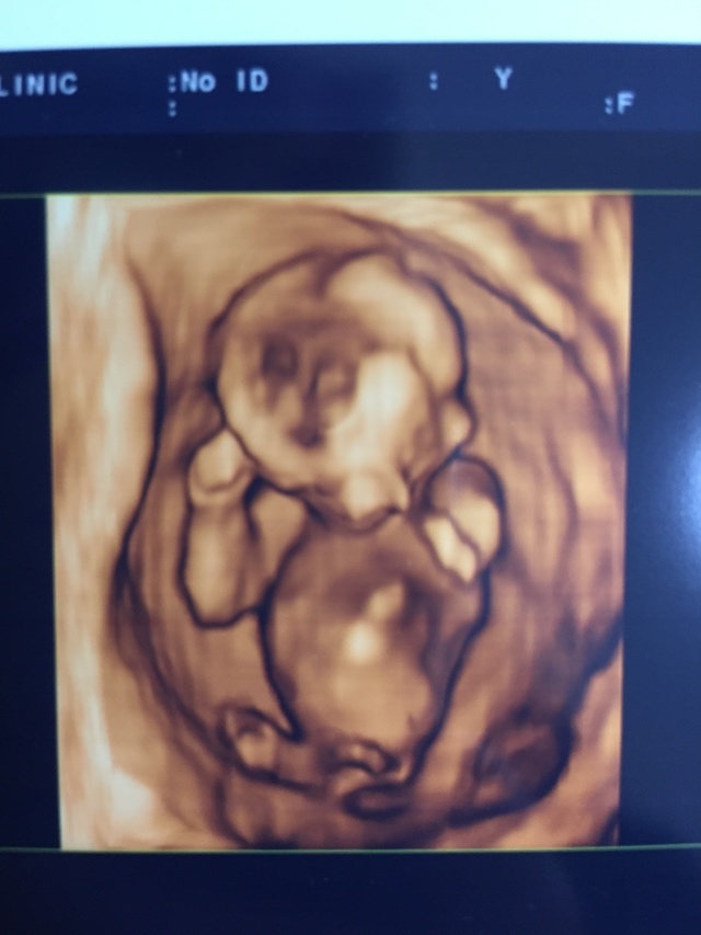 エコー写真 14週1日 14w1d 男の子,妊娠14週,エコー写真,