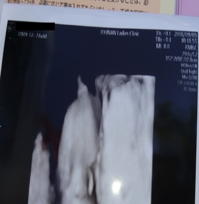エコー写真 25週0日 25w0d 女の子,妊娠,25週,エコー写真
