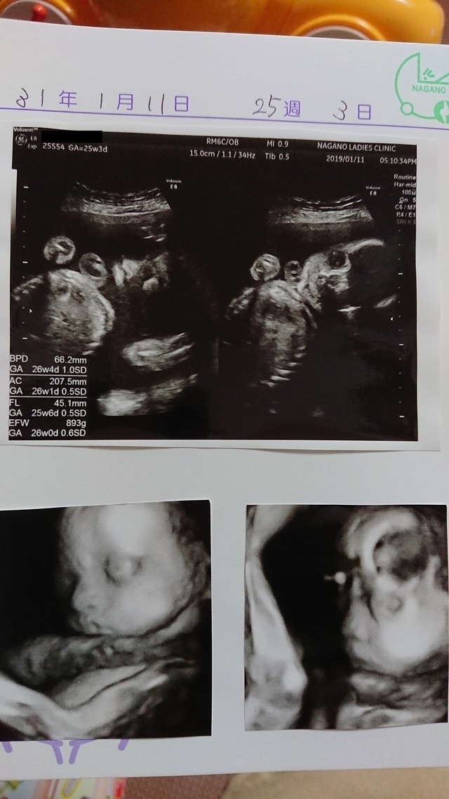 エコー写真 25週3日 25w3d 女の子,妊娠,25週,エコー写真