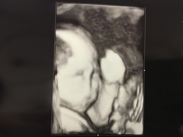 エコー写真 25週3日 25w3d 女の子,妊娠,25週,エコー写真