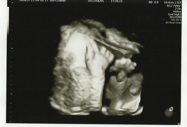 エコー写真 25週4日 25w4d 男の子,妊娠,25週,エコー写真