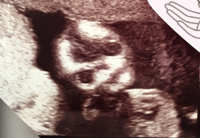 エコー写真 25週5日 25w5d 女の子,妊娠,25週,エコー写真