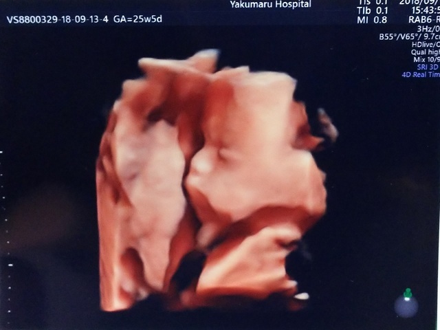 エコー写真 25週5日 25w5d 男の子,妊娠,25週,エコー写真