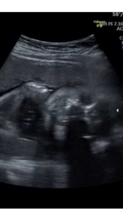 エコー写真 26週1日 26w1d 女の子,妊娠26週,エコー,