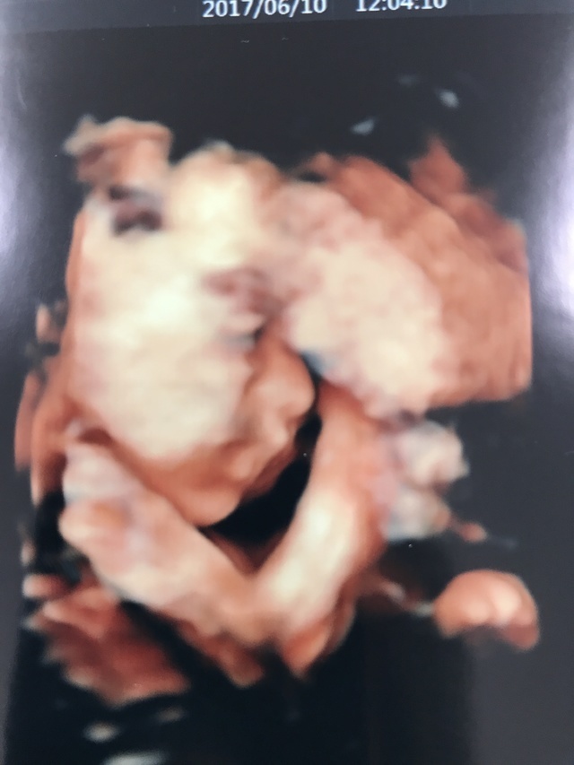 エコー写真 26週1日 26w1d 男の子,妊娠26週,エコー,