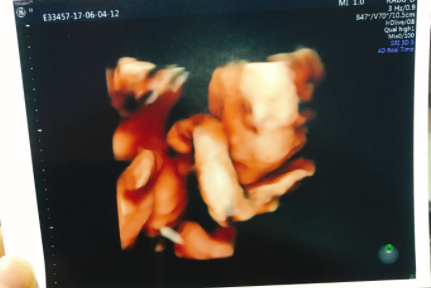 エコー写真 26週4日 26w4d 男の子,妊娠26週,エコー,