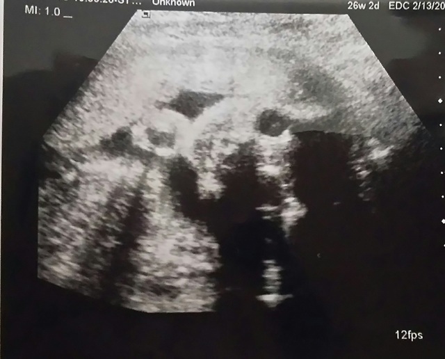エコー写真 26週2日 26w2d 女の子,妊娠26週,エコー,