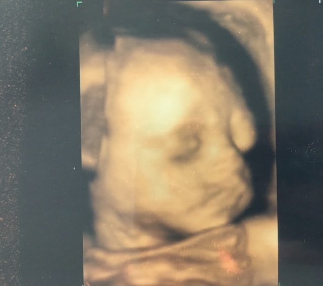 エコー写真 27週6日 27w6d 女の子,妊娠,27週,エコー写真