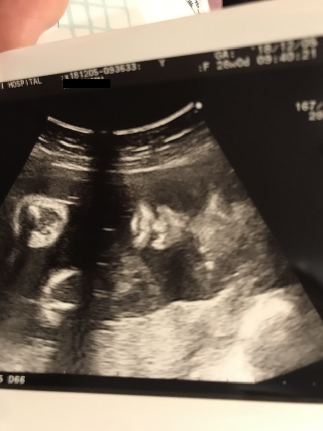 エコー写真 28週0日 28w0d 女の子,妊娠28週,エコー,