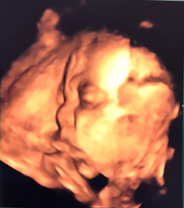 エコー写真 28週2日 28w2d 男の子,妊娠28週,エコー,